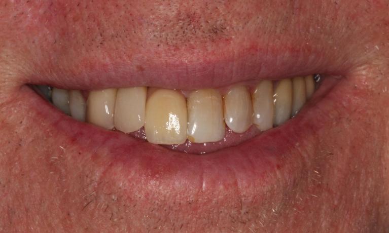 patient with dental bridge to fill gap in Hampton