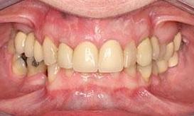 patient with laser gum surgery and new crowns | Fairfield VIC
