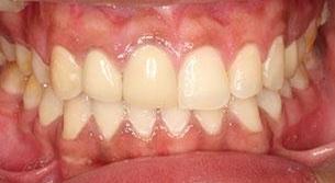 Patient With Smile Makeover | Brighton VIC