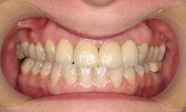 Patient after new crowns and bridge | Melbourne VIC