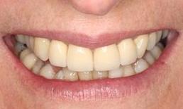 Patient after dental crowns Fairfield VIC