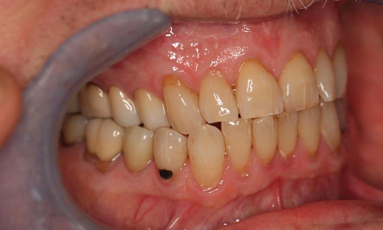 new crowns to replace old metal crowns