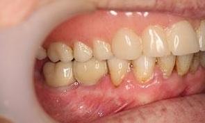 Patient after dentures | Brighton VIC