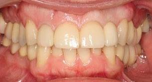 After Full Mouth Reconstruction in Bayside VIC