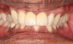 patient after implant supported bridge | fairfield vic