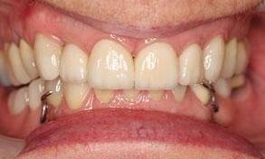 Patient after full mouth rehabilitation | Fairfield VIC
