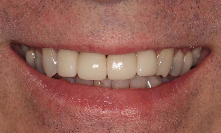 After at home teeth whitening | Fairfield VIC