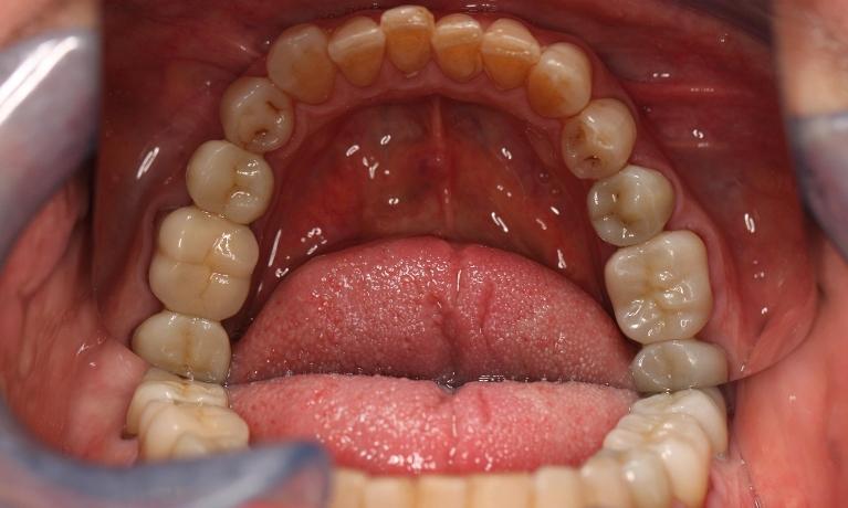 new crowns to replace old metal crowns