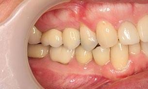 Full Mouth Reconstruction Results | Hampton VIC