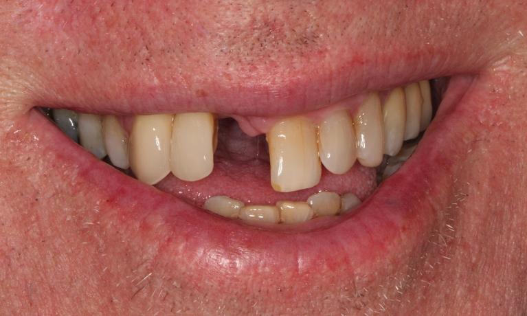 patient with missing tooth in Hampton