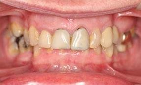 Patient Before New Crowns | Fairfield VIC