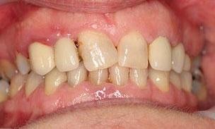 Patient before new crowns and bridges bayside vic