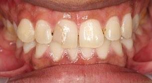 Patient before smile makeover | Brighton vic