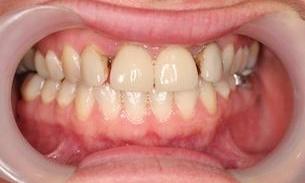 Patient before dental crowns and bridge | Melbourne VIC