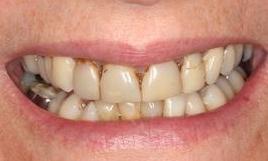 Patient before dental crowns Fairfield VIC