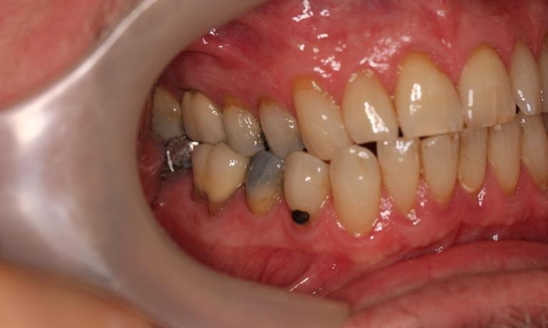 Silver fillings caused discolouration to this patient's teeth