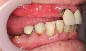 Patient in need of dentures | Brighton VIC