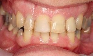 Before Full Mouth Reconstruction | Bayside VIC
