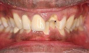 Patient in need of implants | fairfield vic