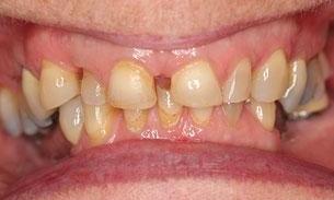 Patient before full mouth rehabilitation | Fairfield VIC