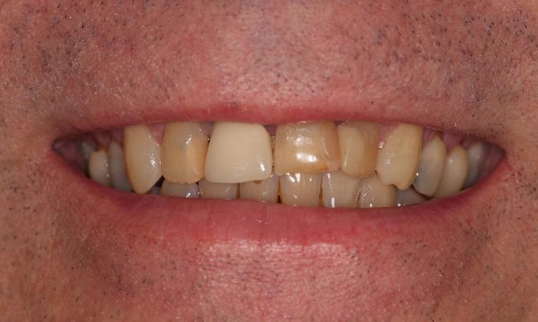 before home teeth whitening | Fairfield VIC