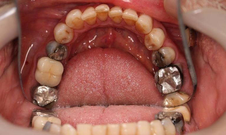 Silver fillings caused discolouration to this patient's teeth