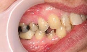 Full Mouth Reconstruction Before | Hampton VIC